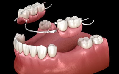partial denture replacing several missing teeth
