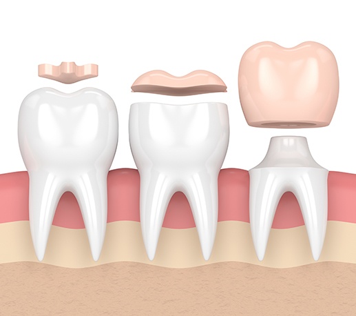 Animated dental crown compared with filling and onlay