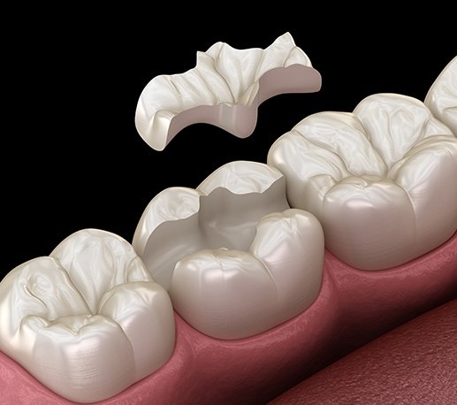 Metal free dental restoration placement