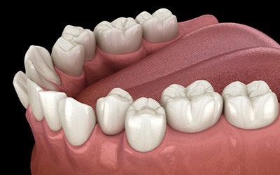 Illustration of crooked teeth