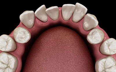 Woman’s smile with gap between front teeth