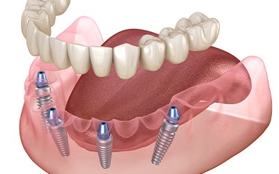 Illustration of All-on-4