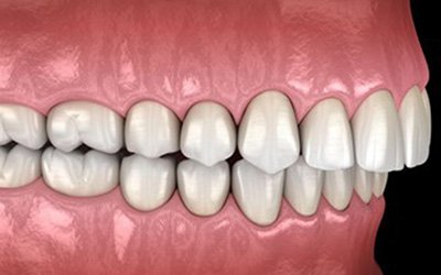 Side-view illustration of an overbite