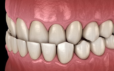 Illustration of an underbite