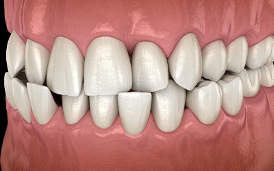 Illustration of a crossbite