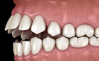 Illustration of an open bite