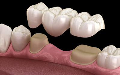 Illustration of traditional dental bridge being placed on prepared teeth