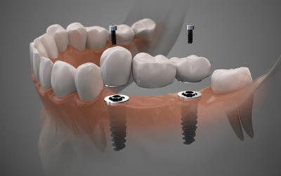Illustration of three-unit dental implant bridge