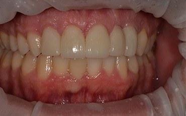 Patient's smile after tooth replacement