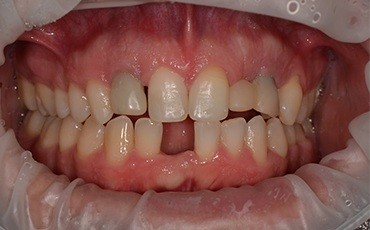 Patient with missing bottom tooth