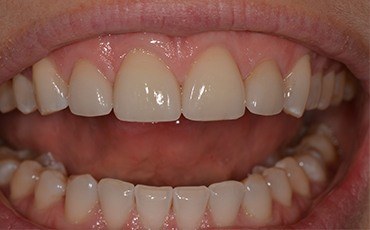 Brilliant white beautiful smile after cosmetic dentistry