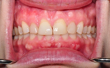 Yellow discolored smile before cosmetic dentistry