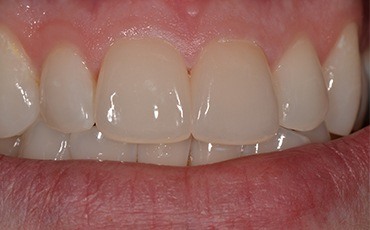 Beautiful smile after cosmetic dentistry