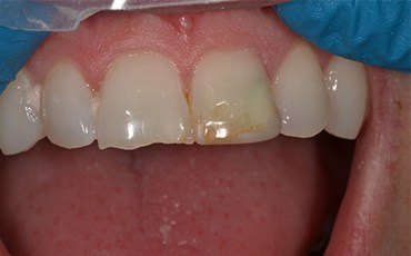 Dark yellow staining on top front teeth