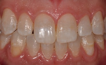 Dental discoloration before cosmetic dentistry