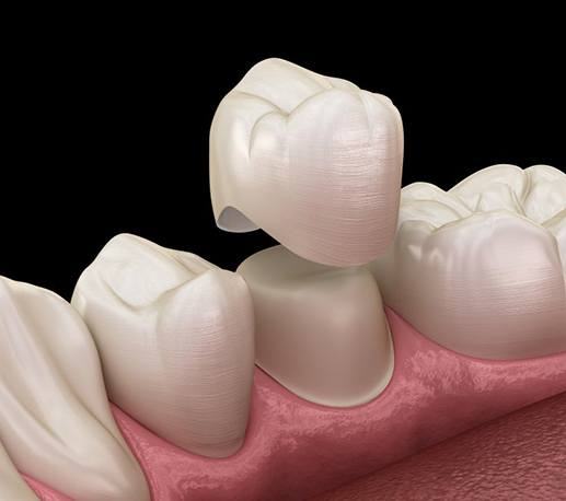 dental crown being placed over bottom tooth 