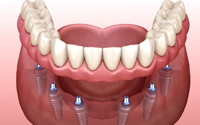 full denture supported by six dental implants
