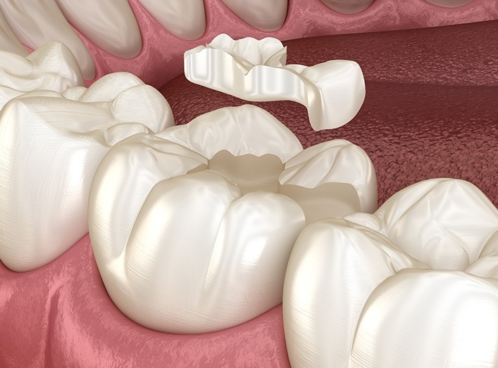 Aniamted tooth-colored filling placement