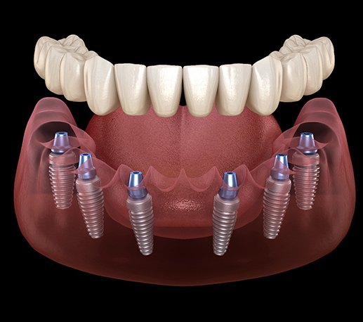 Implant dentures illustration