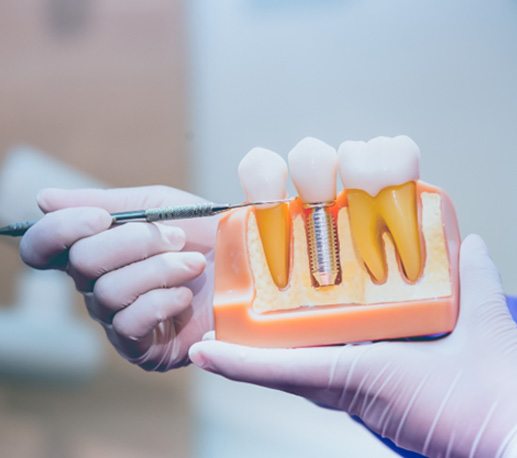 Dentist pointing to a dental implant