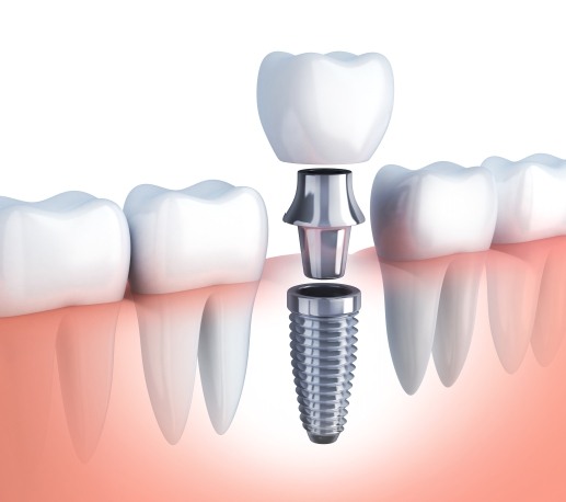 Animated dental implant supported dental crown placement