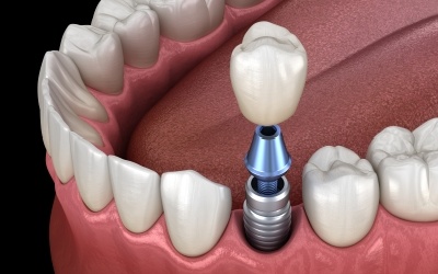 A 3D rendering of a single dental implant and crown