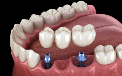 Animated dental implant supported fixed bridge placement