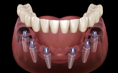 A 3D illustration of an implant denture