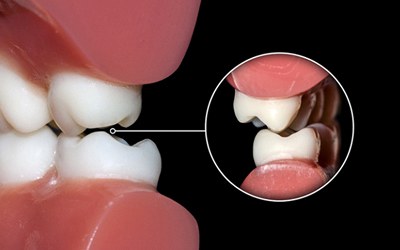 a model of teeth grinding against each other