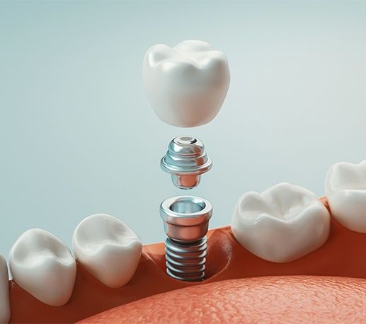 Animated dental implant supported dental crown placement