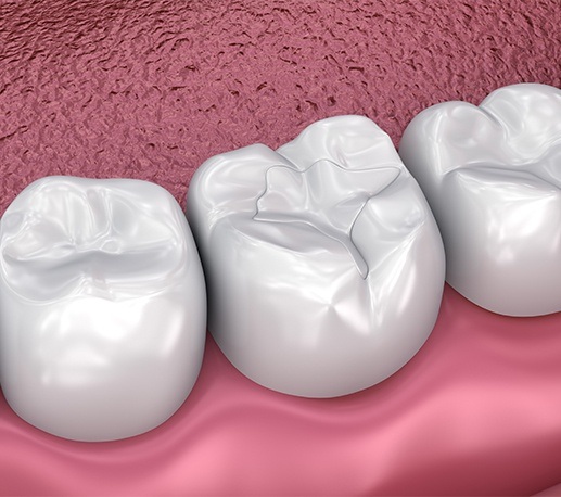 Animated smile with dental sealants