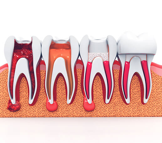 Animated stages of the root canal therapy process