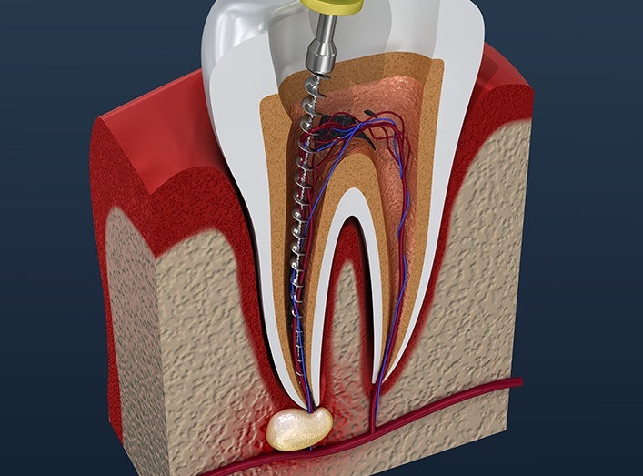 Animated tooth during root canal therapy