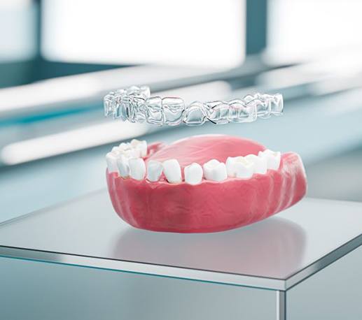 Illustration of clear aligner above misaligned teeth