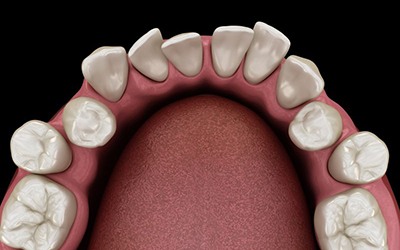 Illustration of crooked teeth viewed from above