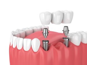 dental implants 3D illustration
